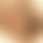 Seborrhoische Keratose, Auflichtmikroskopie: gepunzte Oberfläche mit zahlreichen z.T. weißen, ges...