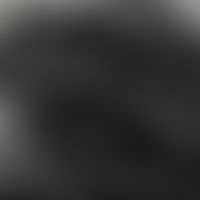 Trichoepitheliom konventionelles, Laser-Scanning-Mikroskopie: multiple ovaläre Tumornester mit Pa...