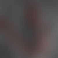 Pemphigus foliaceus. Laser Scanning Mikroskopie: intraepidermale Kontinuitätstrennung (rote Marki...