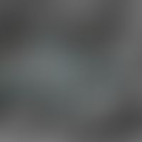 Melanom superfiziell spreitendes auf dem Boden eines dermalen Naevuszellnaevus, Laser Scanning Mi...