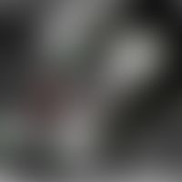 Keratoakanthom, Laser Scanning Mikroskopie:&nbsp;Epidermiskegel mit&nbsp; ausgeprägter Hornschich...