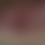 Aktinische Keratose (Cheilitis actinica):&nbsp;&nbsp;Unterlippe flächenhafte Leukoplakie;&nbsp;kl...