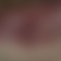 Aktinische Keratose (Cheilitis actinica):&nbsp;&nbsp;Unterlippe flächenhafte Leukoplakie;&nbsp;kl...