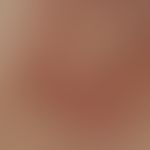 Basalzellkarzinom sklerodermiformes, Auflichtmikroskopie, narbig erscheindender Fleck, derb, mit ...