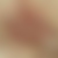 Basalzellkarzinom solides. Auflichtmikroskopie, Scharf begrenzte, glänzende, derbe Papel mit ange...