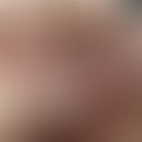 Onychophagie:&nbsp; Onychodystrophie durch Beißtätigkeit. Nagelhäutchen trocken und unregelmnäßig...