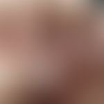 Onychophagie:&nbsp; Onychodystrophie durch Beißtätigkeit. Nagelhäutchen trocken und unregelmnäßig...