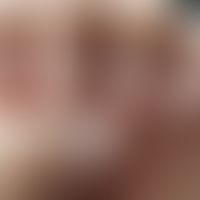 Onychophagie:&nbsp; Onychodystrophie durch Beißtätigkeit. Nagelhäutchen trocken und unregelmnäßig...