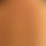 Xeroderma pigmetnosum: 60jährige Patientin. Im Alter von 33 Jahren Lentigo maligna Melanom Wange....