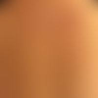 Xeroderma pigmetnosum: 60jährige Patientin. Im Alter von 33 Jahren Lentigo maligna Melanom Wange....
