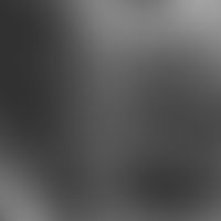 Trichoepitheliom, desmoplastisches, Laser Scanning Mikroskopie,&nbsp; unruhiges Epithel mit unreg...