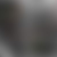 Trichoepitheliom, desmoplastisches, Laser Scanning Mikroskopie,&nbsp; unruhiges Epithel mit unreg...