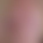 Hirsuties papillaris penis: weißliche und Haut-farbene Papeln an der Corona glans penis. Die &nbs...