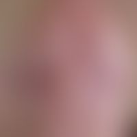 Hirsuties papillaris penis: whitish and skin-colored papules on the corona glans penis, angiofibr...