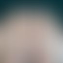 Leukonychia totalis: complete, opaque white coloration of the non-thickened toenails (milk glass ...