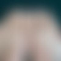 Leukonychia totalis:&nbsp;komplette, undurchsichtige Weißfärbung der nicht-verdickten Fußnägel (M...