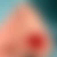 Insular flap, myocutaneous: defect at the transition from the nostril to the tip of the nose
