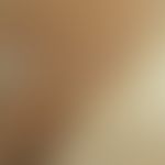 Pityriasis versicolor: 50jährige Frau. Schon seit Jahren immer Pityriasis versicolor oberer Rücke...
