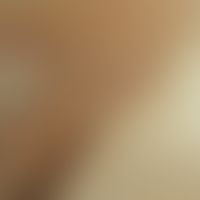 Pityriasis versicolor: 50-year-old woman. for years always pityriasis versicolor upper back. this...
