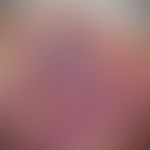 Bilobed flap: sclerodermiform basal cell carcinoma at the tip of the nose on the left side; the t...