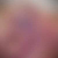 Bilobed flap: sclerodermiform basal cell carcinoma at the tip of the nose on the left side; the t...