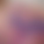 Bilobed flab at the tip of the nose on the left. the rotation is about 100°. the centre of rotati...