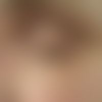 Syringome disseminated: multiple, dense, in places confluent, skin-coloured, 0.1 - 0.2 cm large, ...