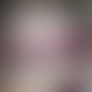 Prurigo-artiges Krankeitsbild unter Olmesartan, das zusammen mit den enteritischenSympotmen auftr...