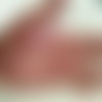 Bullöses Pemphigoid unter&nbsp;Rivaroxaban (entommen aus&nbsp;Chohan SA et al. 2020)
