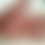 Pemphigoid bullöses: Arzneimittel-induziertes bullöses Pemphigoid (Rivaroxaban). (entommen aus: F...