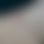 Ekkrines Porom:&nbsp;derber solitärer Knoten mit verruköser Oberfläche.
