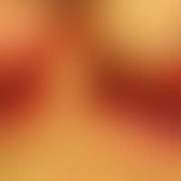 Psoriasis inversa: 85-year-old patients, Zn of severe exanthematic psoriasis years ago, all heale...