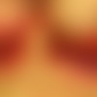 Psoriasis intertriginosa: 85 years old patients, Zn of severe exanthematic psoriasis years ago, a...