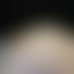 Cornu cutaneum: 73-year-old man. considerably actinic damaged skin. numerous actinic keratoses an...