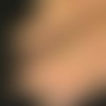 Onycholysis: Woman, 72 years. January to May chemotherapy with paclitaxel. presentation in June. ...