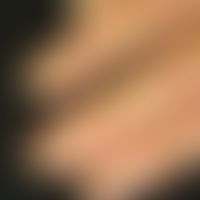 Onycholysis: Woman, 72 years. January to May chemotherapy with paclitaxel. presentation in June. ...