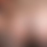 Strongyloidose unter dem klinischen Bild der Larva recurrens
