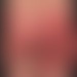 Cytostatic drugs: SDRIFE (so-called Baboon syndrome): occurred after application of a taxane cyto...