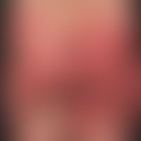 Cytostatic drugs: SDRIFE (so-called Baboon syndrome): occurred after application of a taxane cyto...