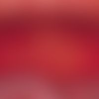 Oral mucositis: severe extensive, painful mucositis of the entire oral mucosa after high-dose che...