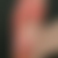 Hand-foot syndrome under cytostatic therapy
