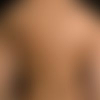 Blaschko-Linien,&nbsp;epidermales Hamartom (Naevus verrucosus): bizarres verwirbeltes Muster dies...