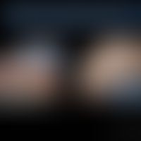 MSMD durch kompletten ISG15-Defekt. Disseminierte und lokalisierte Infektion durch Mykobakterien....