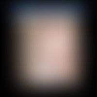 CANDLE syndrome: recurrent multiform exanthema with anular (circle) and erythema muldtiforme-like...