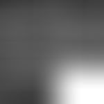Macular degeneration (OCT imaging) before and after therapy (12 months), taken from: Int J Ophtha...