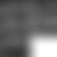 Macular degeneration (OCT imaging) before and after therapy (12 months), taken from: Int J Ophtha...