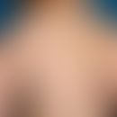 Hypomelanosis Ito: Striped and extensive depigmentation, no other symptoms, no other organic malf...