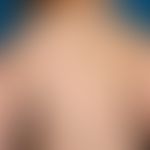 Hypomelanosis Ito: Streifige und flächige Depigmentierungen. Keine sonstigen Beschwerden, keine w...