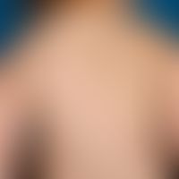 Hypomelanosis Ito: Striped and extensive depigmentation, no other symptoms, no other organic malf...