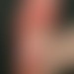 Hand-foot syndrome occurred under therapy of tyrosine kinase inhibitors
